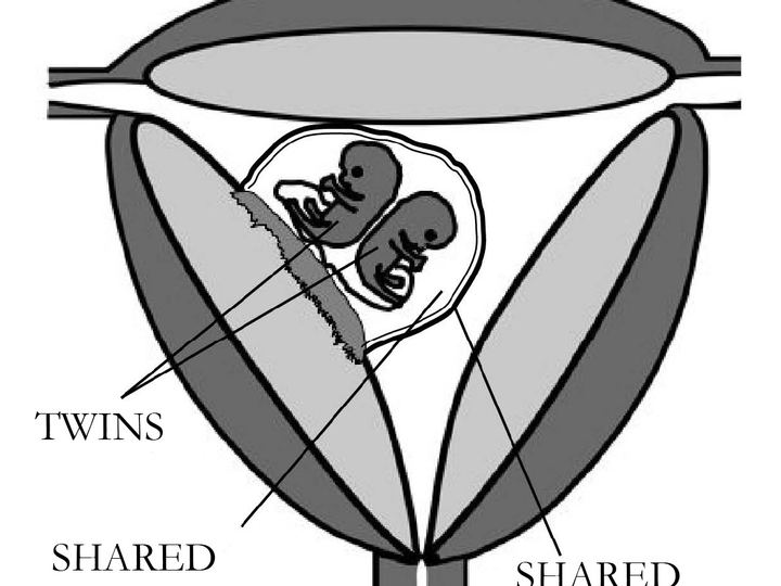 Black and white diagram of a womb holding two small embryos inside one shared amniotic sac and one shared chorion
